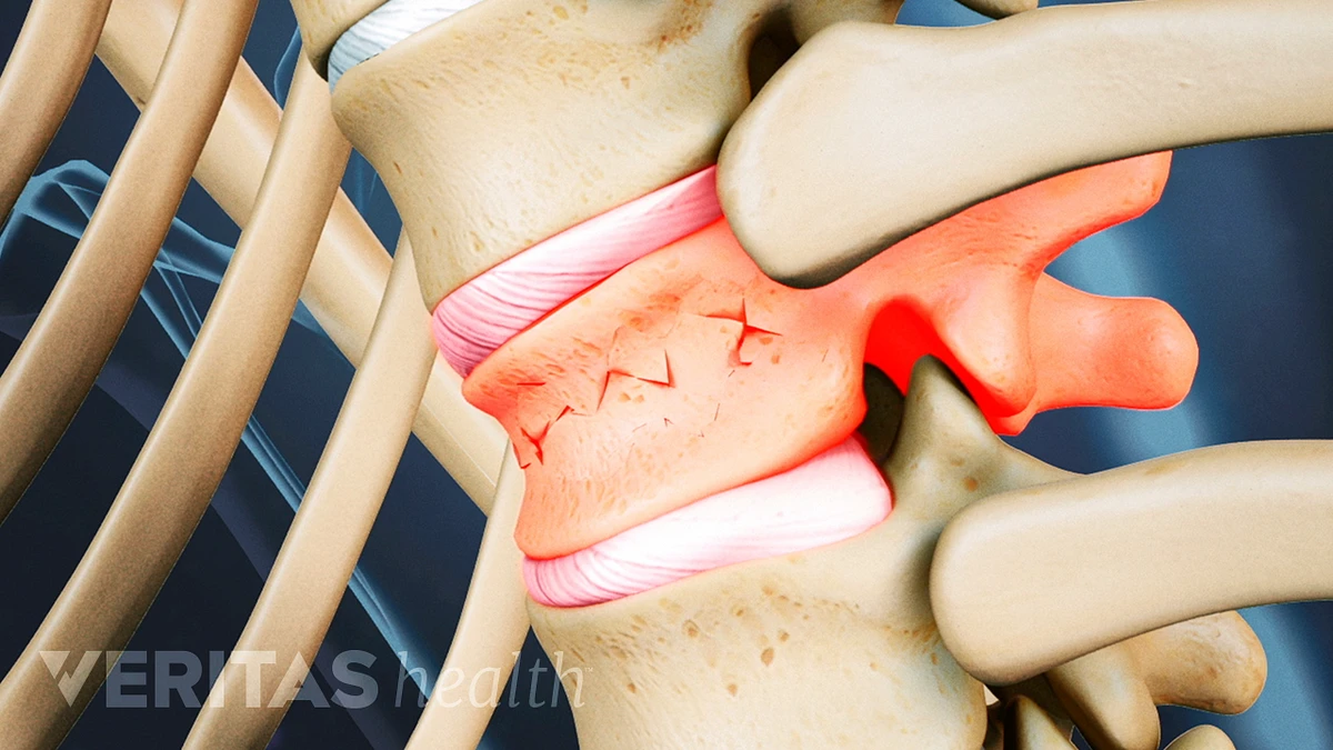 Figure 2 from Vertebral compression fractures in the elderly