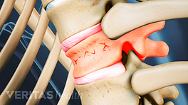 Compression fracture in a thoracic vertebra