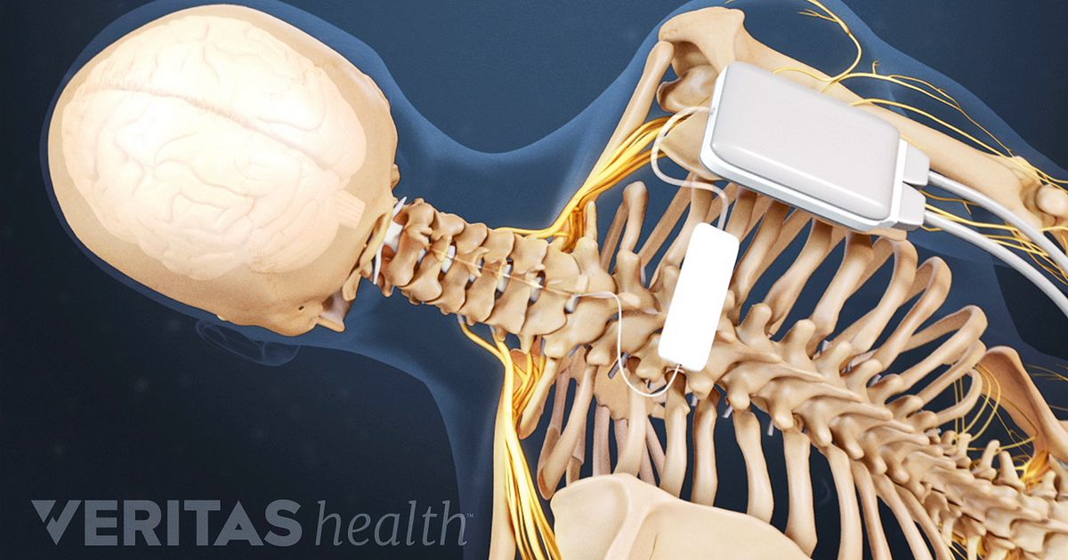 Why Do I Need Psychological Screening for Spinal Cord Stimulation?