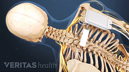 Medical illustration showing the placement of a spinal cord stimulator