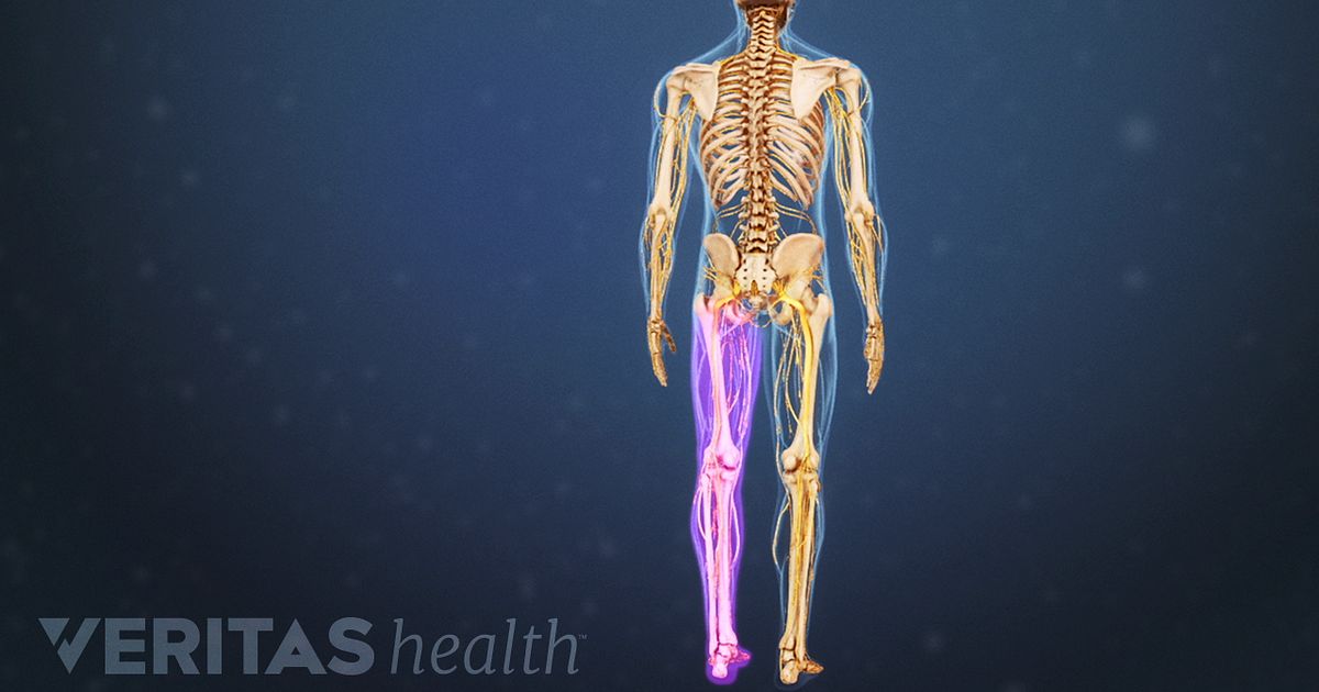 Failed low back surgery