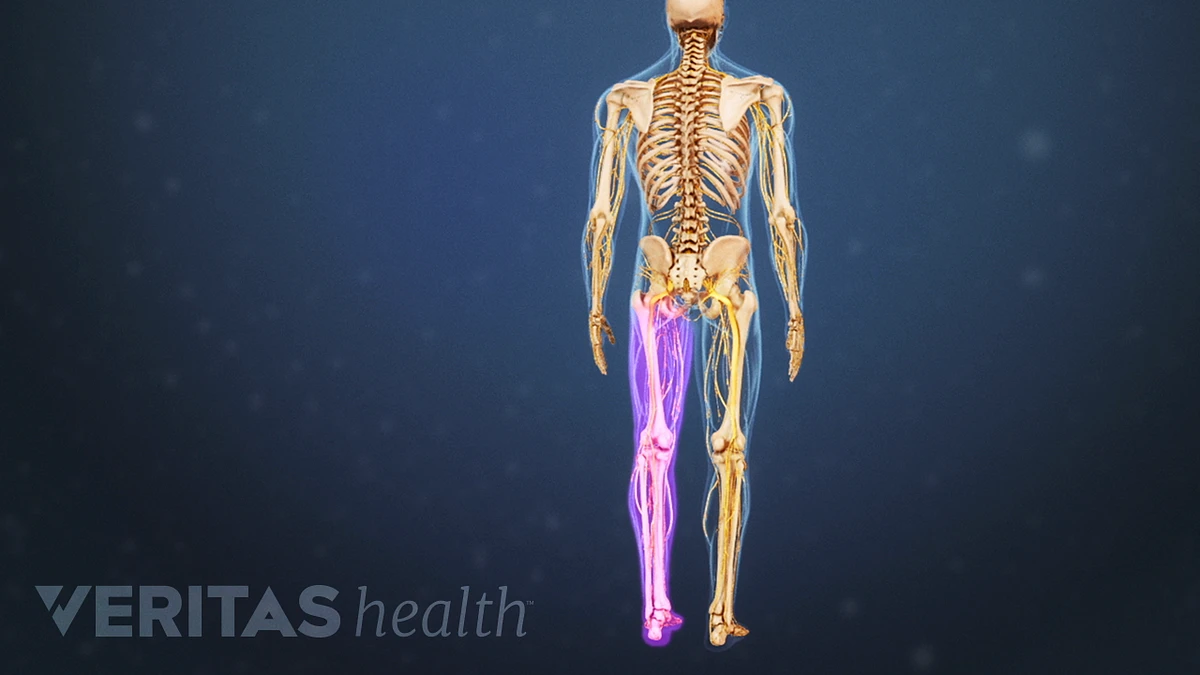 What Is Sciatica, and How Is It Treated?