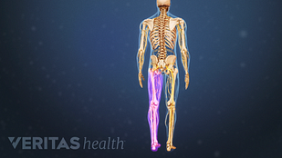 Animated video still of sciatic pain radiating down path of sciatic nerve root