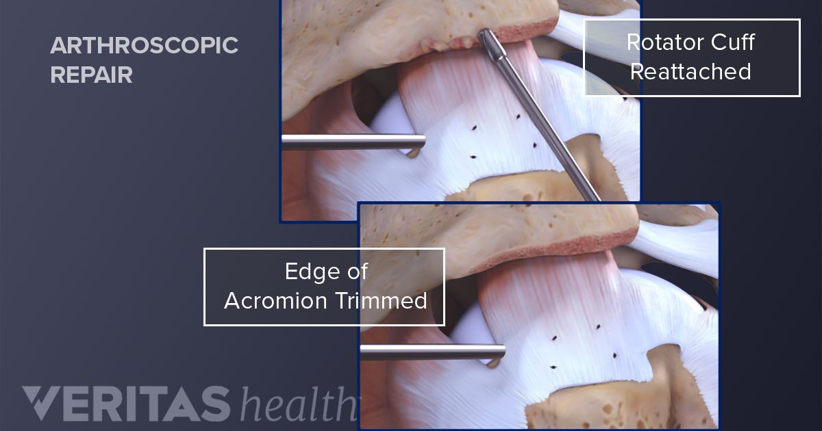 Different Types of Rotator Cuff Surgery