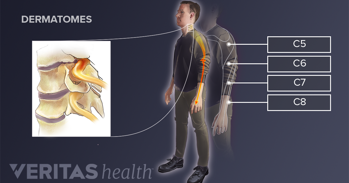 Cervical Radiculopathy Symptoms