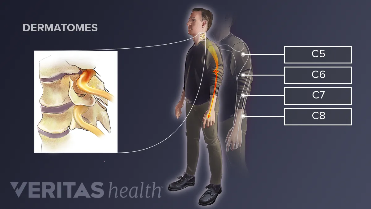 One-Sided MS Symptoms: The Experience and Its Explanation