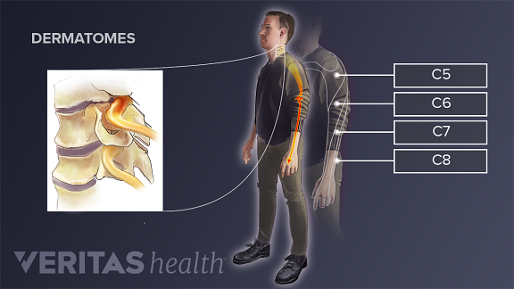 Medical illustration of the pain areas of different compressed nerve roots in the cervical spine