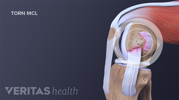 Anterior view of a torn MCL in the knee joint