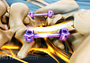 Posterior view of the lumbar spine showing screws and rods from fusion.