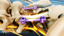 Screws used in posterior lumbar interbody fusion