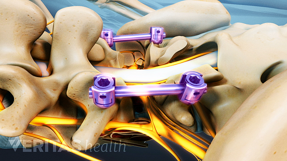 Posterior view of the lumbar spine highlighting the location of a PLIF.