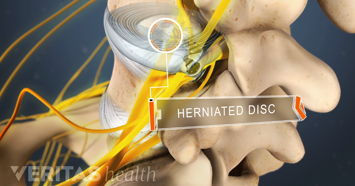 little disc herniation