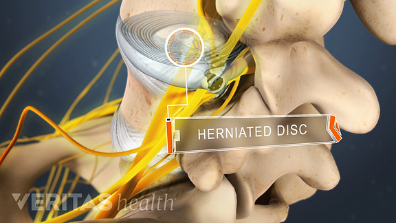 Lumbar Herniated Disc Video