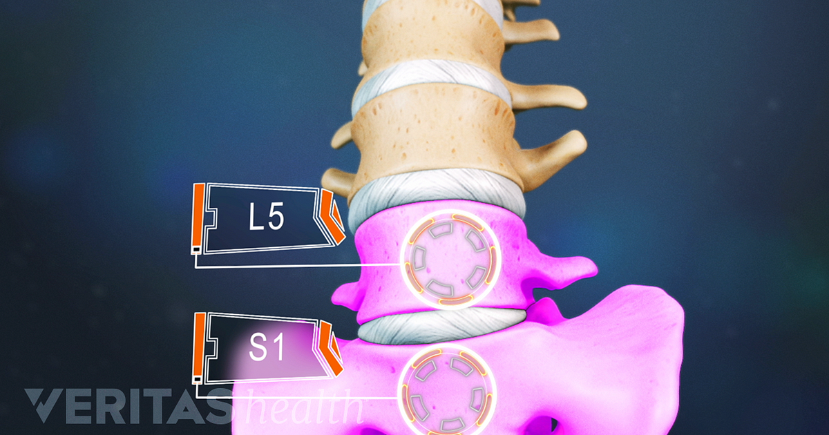 lumbar l5 s1