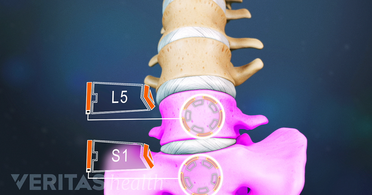L5 S1 Treatment l5-s1-treatment