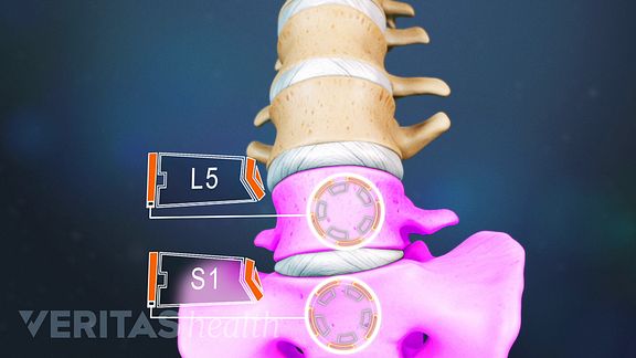 The two lowest segments of the lumbar spine, which includes L5-S1, carry the most weight and have the most movement, making the area prone to injury.