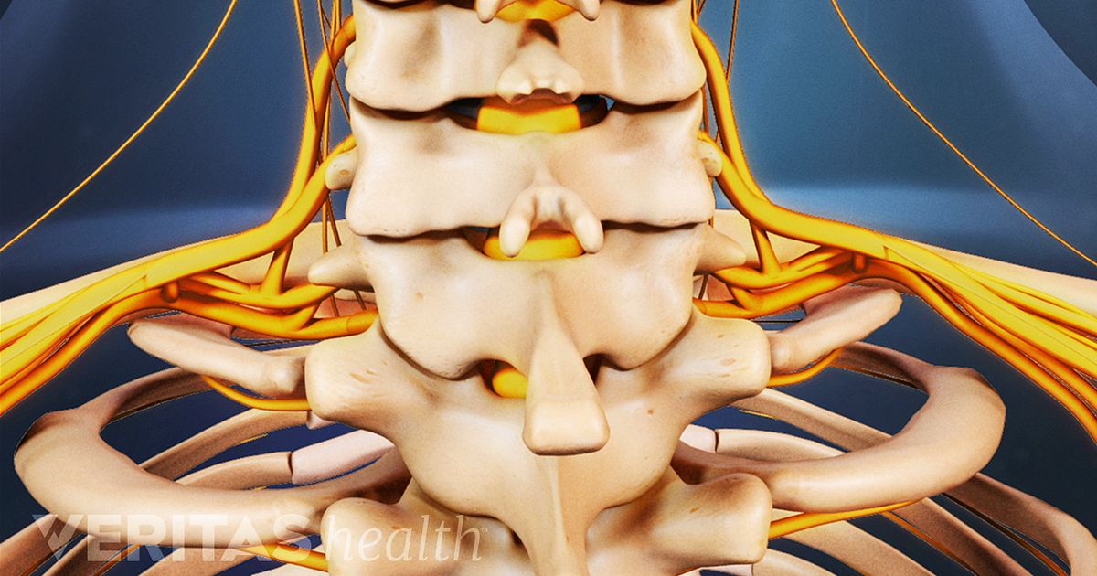 Opciones de tratamiento para la enfermedad degenerativa de disco cervical