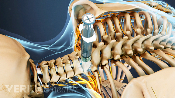 How Cervical Selective Nerve Root Blocks Can Ease Neck Pain