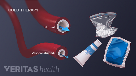 医疗插图示出了作为不同形式的冷疗的响应正常和vasoconstrcited血管