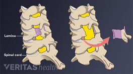 Posterior view of the cervical spine showing the cervical laminectomy labeling the lamina and spinal cord.
