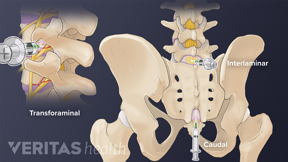Omurilikte transforaminal, interlamniar ve kaudal enjeksiyonların enjeksiyon bölgesi