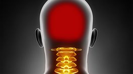 What Is Cervicogenic Headache What Is Cervicogenic Headache