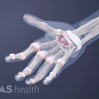 Palmar view of a hand with rheumatoid arthritis in the joints.