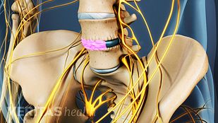 Bone Graft