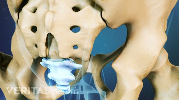 Coccydynia (Tailbone Pain)