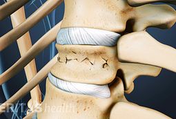 Spinal Compression Fracture Video