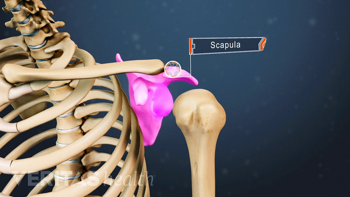 A Broken Shoulder: Scapula Fracture