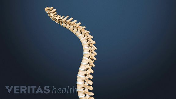 Kyphosis