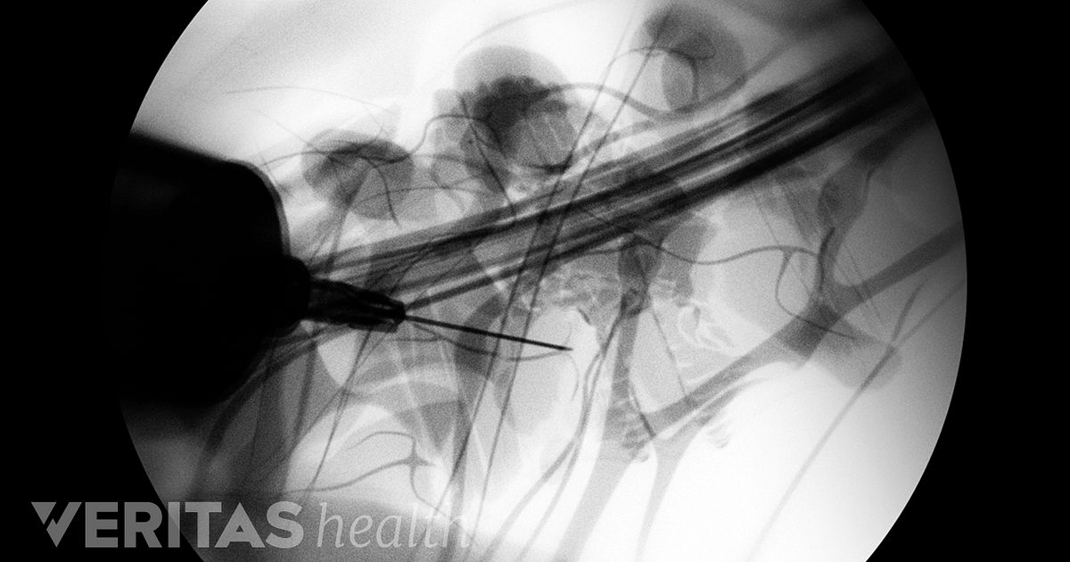 Injections For Back Pain Relief   Medial Branch Nerve Block Xray Guidance 