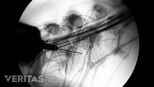 facet block definition back pain and neck pain medical glossary facet def