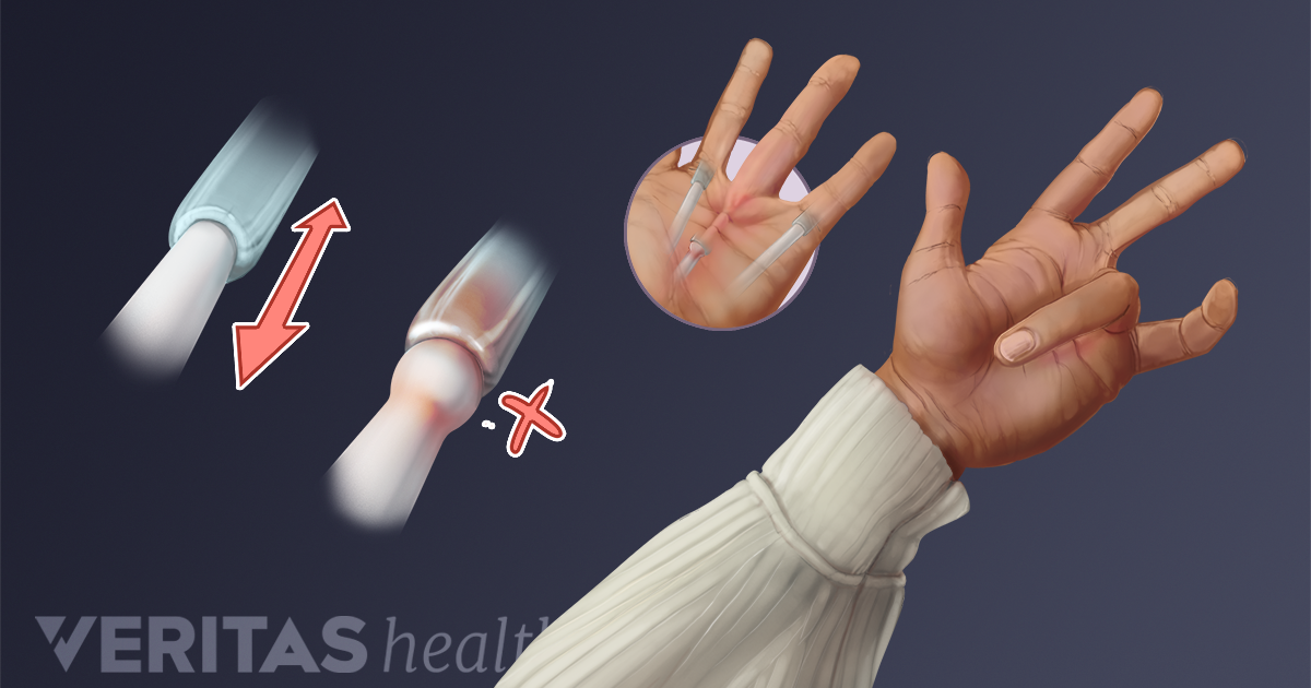 trigger-finger-release-percutaneous-and-open-surgery