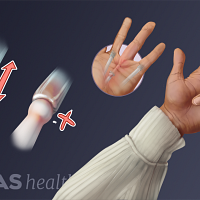 Palmar view of a hand with the ring finger bent showing how the joint locks up.