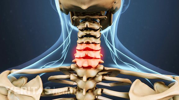 neck-strain-causes-and-remedies