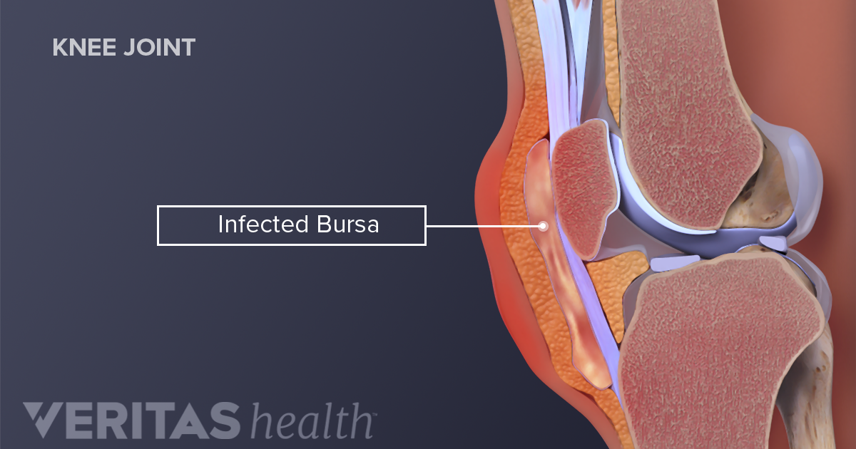 Septic Bursitis | Arthritis-Health