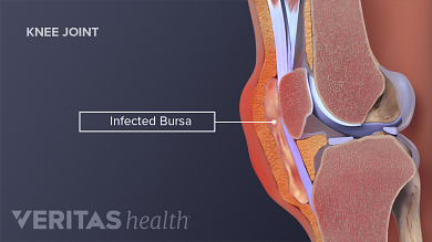 torn bursa sac knee