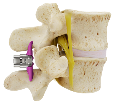 Diagram of the vertebrae after the Vertiflex Procedure.