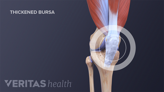 Q&A: Diagnosing a Swollen Knee