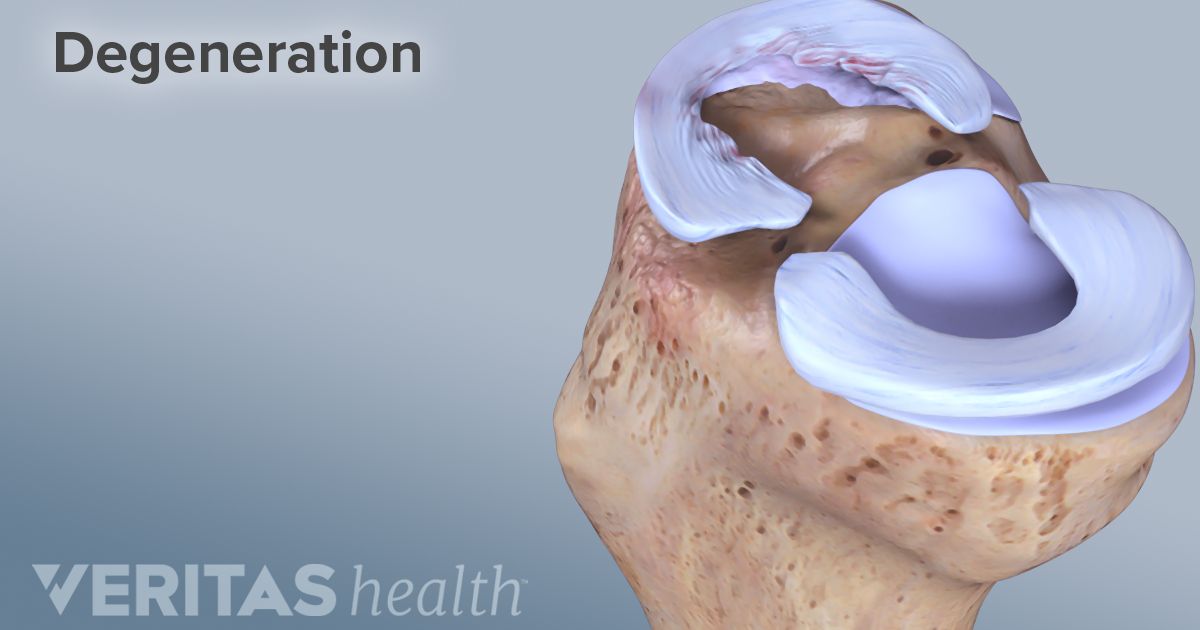 How Age Affects Your Risk for a Meniscus Tear