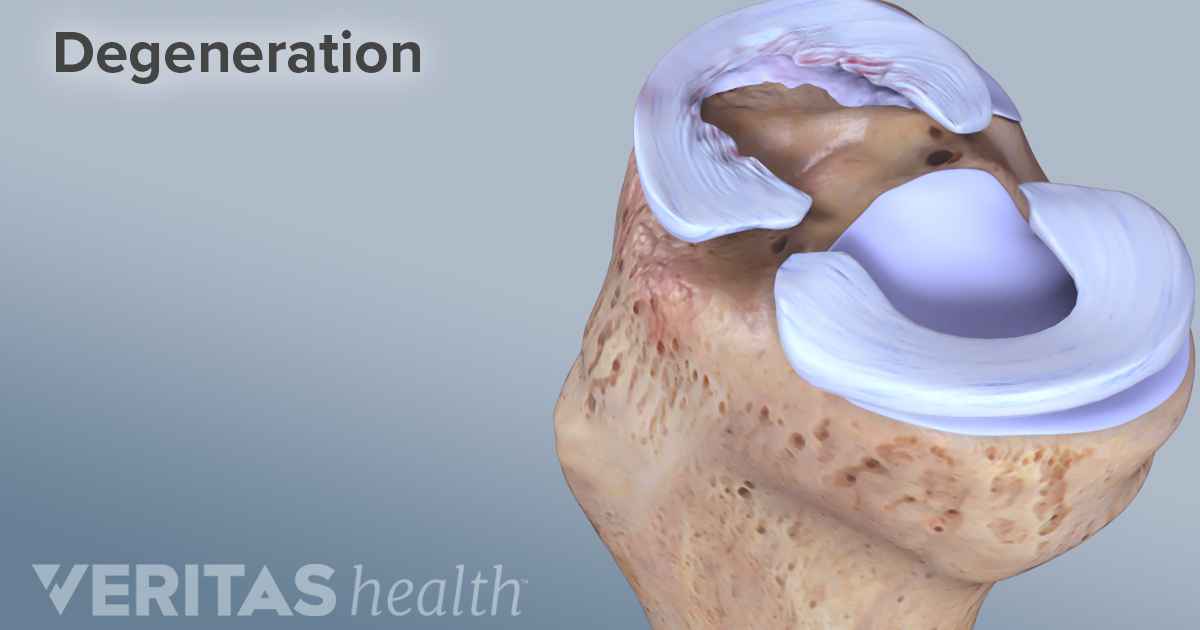 Causes of Meniscal Tears