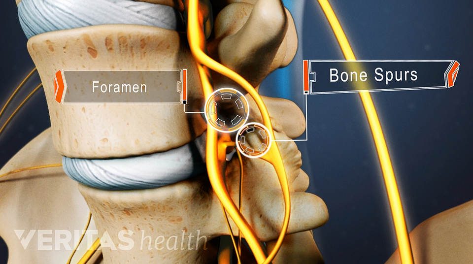 Slideshow: 5 Conditions that Commonly Cause Sciatica