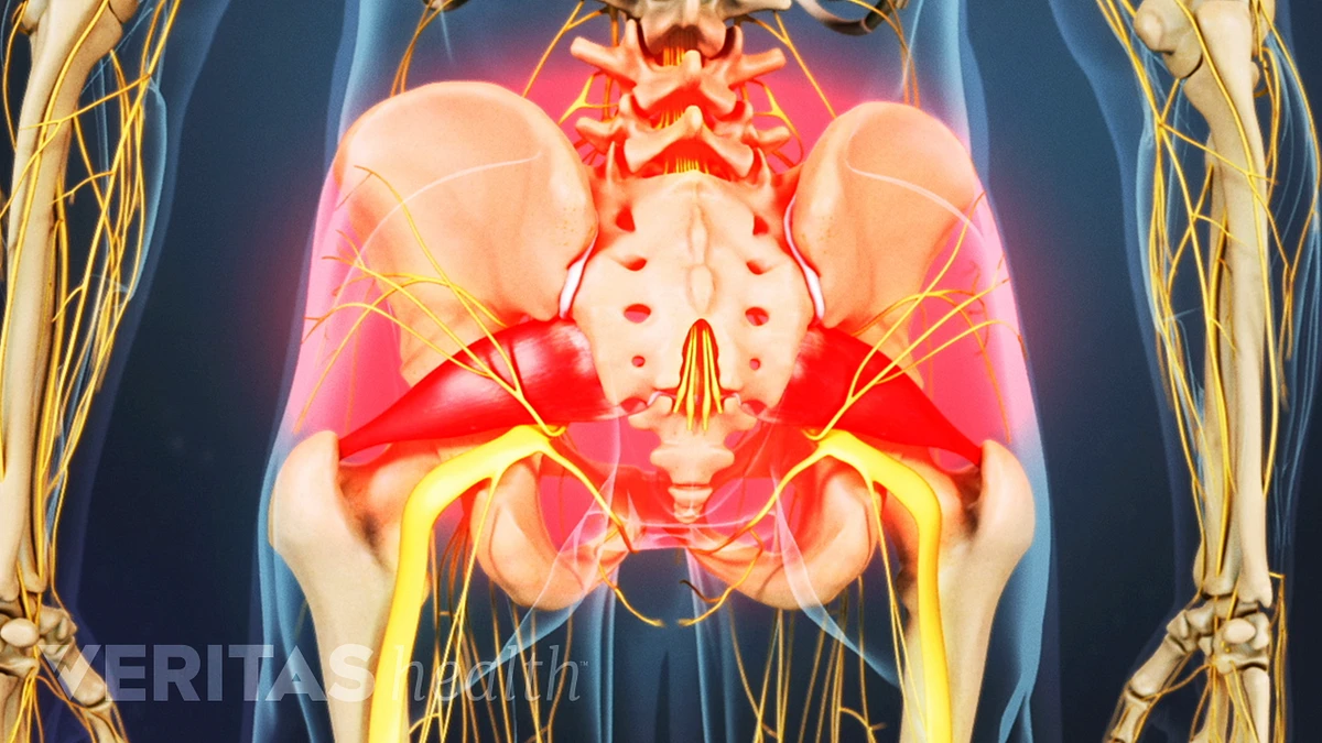 What Does Piriformis Syndrome Feel Like?