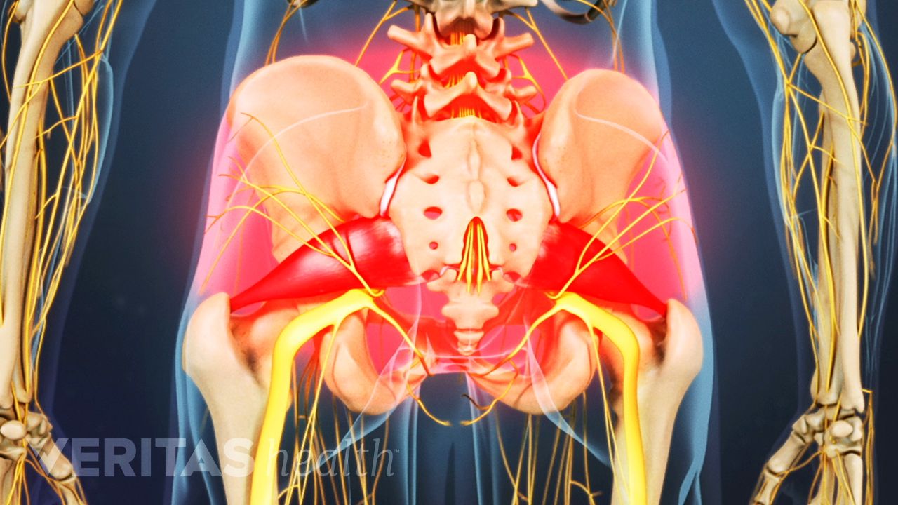 sindrome de piriforme pdf