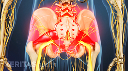 Posterior view of the pelvis showing pain in the pelvis and lower back.