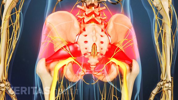 Understanding Piriformis Syndrome