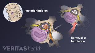 说明后路椎间盘切除术的步骤