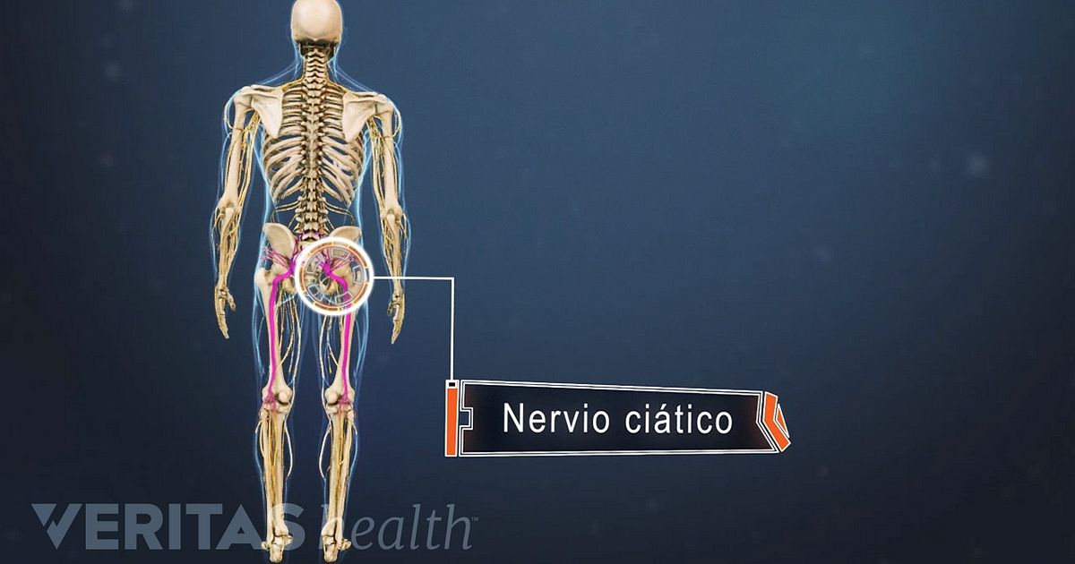 De posterior ciática causas la